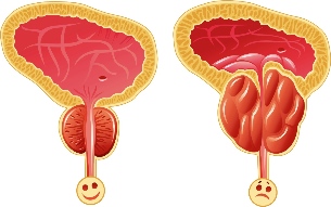 Normal e próstata inflamada