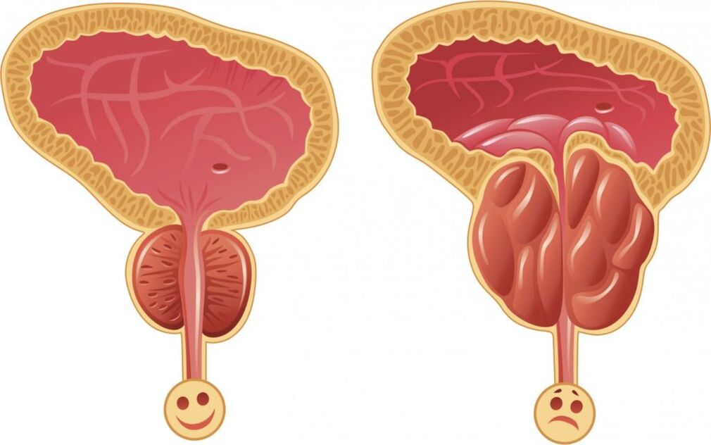 Síntomas da inflamación da próstata nos homes